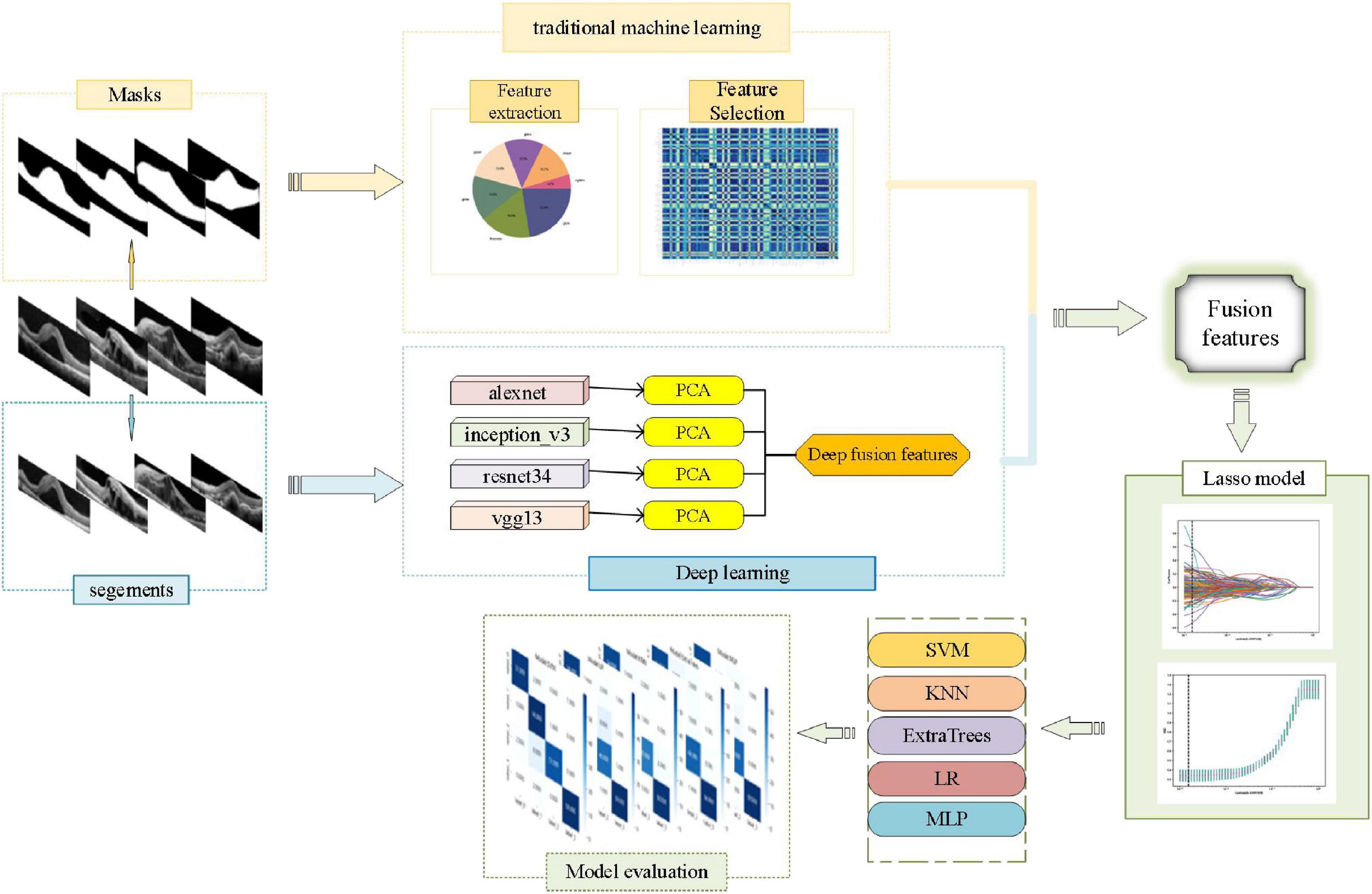 Artificial intelligence method based on multi-feature fusion for automatic macular edema (ME) classification on spectral-domain optical coherence tomography (SD-OCT) images